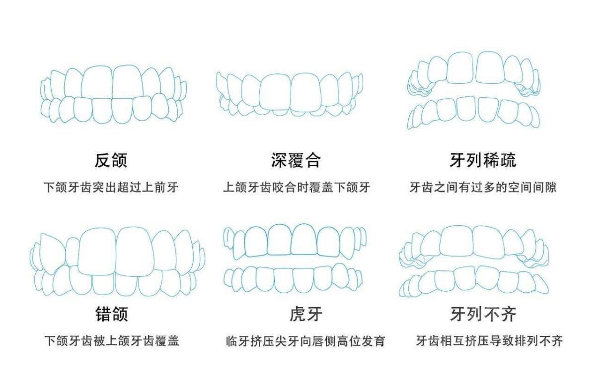 周权医生可矫正的畸形牙齿症状