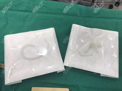 人工材料耳再造