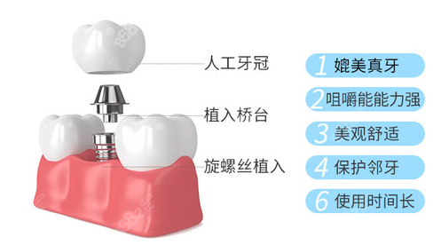 杭州牙齿种植哪家好呀？