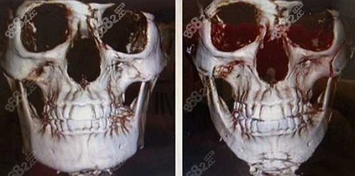 邱立東的下頜角手術(shù)實(shí)例圖 邱立東的下頜角手術(shù)實(shí)例圖