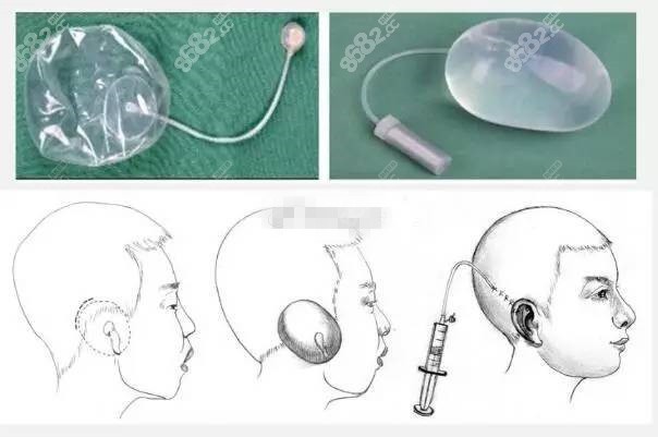 张天宇做全包法耳再造的手术过程
