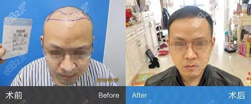 碧莲盛植发际线真人实例