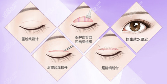 广州双眼皮手术哪家医院好呢？