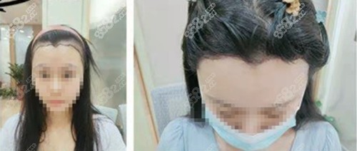 碧莲盛不剃发植发前后对比