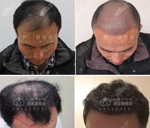 碧莲盛头顶加密种植对比照