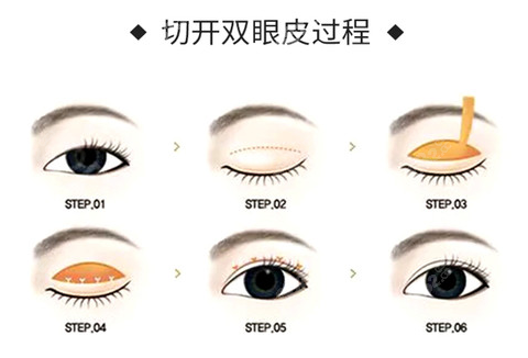 双眼皮手术切开过程示意图
