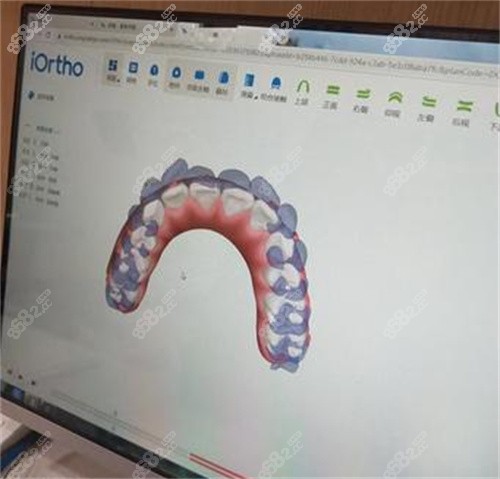 3D口扫展示