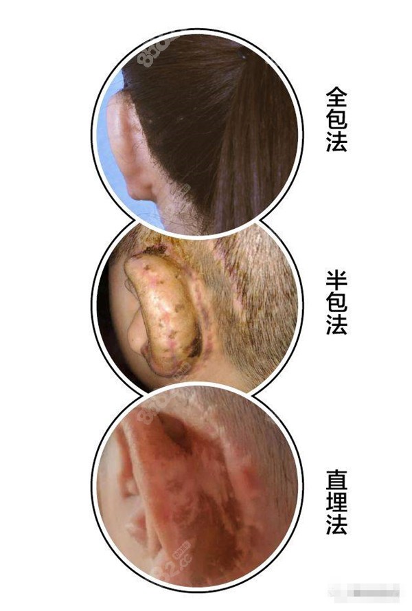 小耳畸形修复用到的全包法、直埋法、半包法