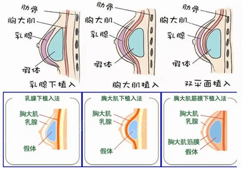 假体隆胸切口位置在哪