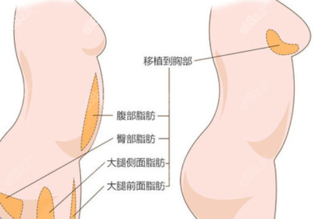 泉州美莱华美整形脂肪隆胸脂肪选择部位