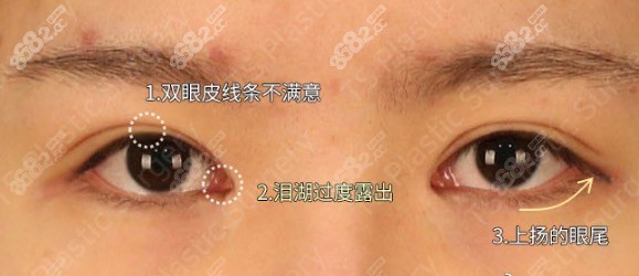 韩国TS内眼角复原术方案设计