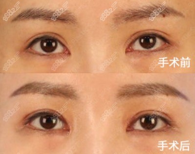 韩国TS内眼角疤痕重建手术前后对比