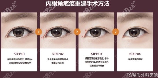 韩国TS内眼角疤痕重建手术方法