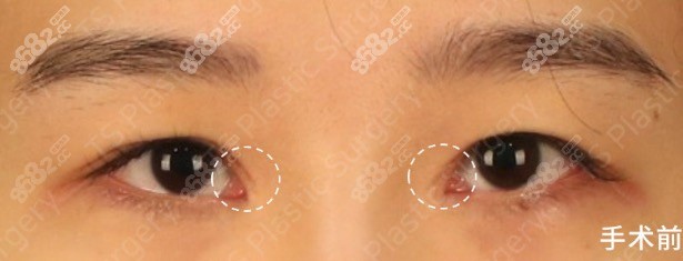 韩国TS内眼角疤痕重建手术前
