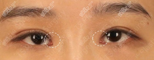 韩国TS内眼角疤痕重建手术后