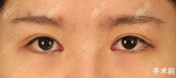 韩国TS内眼角复原术手术前照片