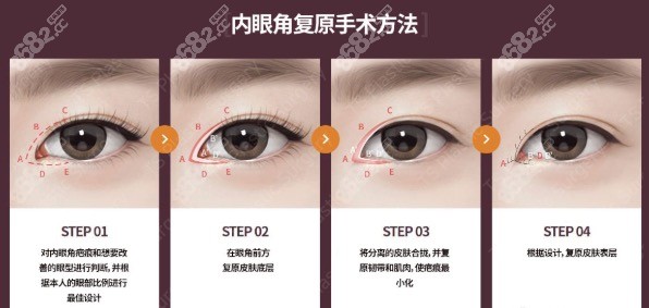 韩国TS内眼角复原术方法