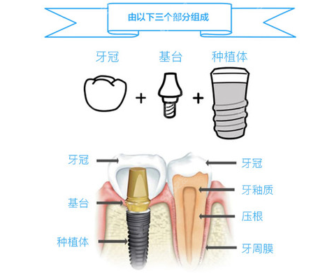 西安种植牙齿哪个医院好呢？