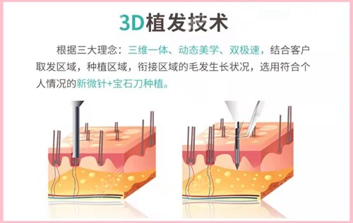 <!--<i data=20240705-sp></i>-->植发技术优势
