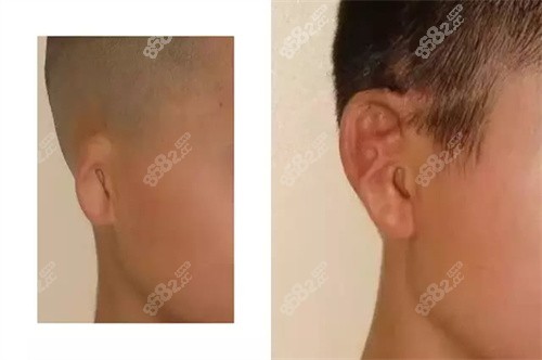 小耳畸形矫正前后变化大吗