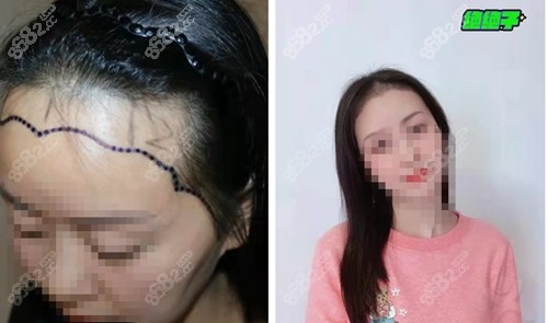 大麦微针植发际线恢复前后对比明显