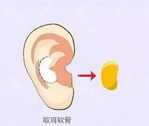 李昕做鼻子怎么样