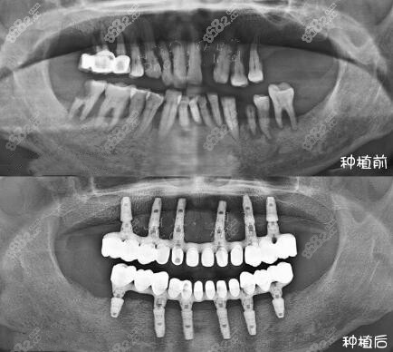 巩新科医生完成的all-on-6全口种植牙病例展示对比图
