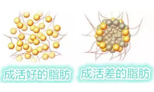 长沙美莱潘卫峰自体脂肪填充技术