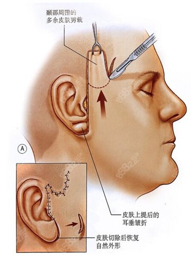 MACS小拉皮原理