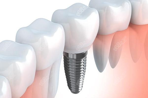 <!--<i data=20240705-sp></i>-->植联口腔的种植牙价格