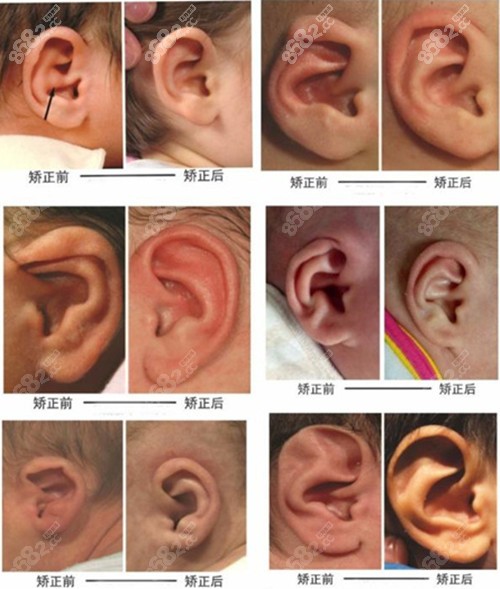 不同耳畸形矫正前后对比图