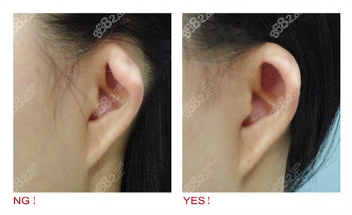 耳朵畸形整形前后对比照片