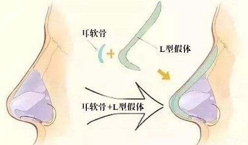 李昕做耳软骨鼻综合多少钱
