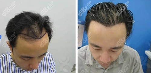 碧莲盛种植发际线前后对比照