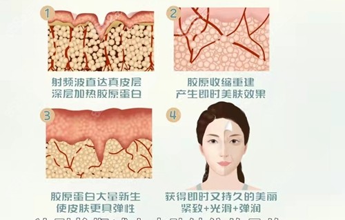 射频紧肤的功效