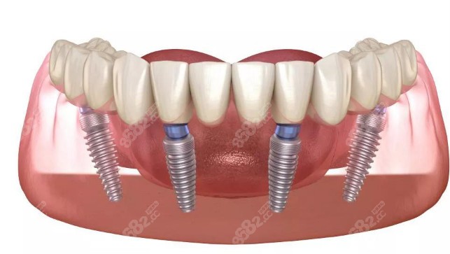 图解all-on-4种植牙的形态