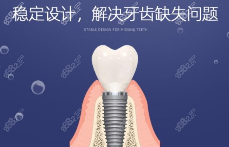 上海鼎植口腔种植牙优势