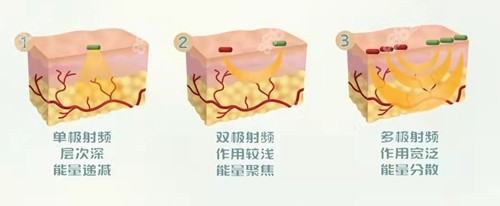 射频仪器的分类