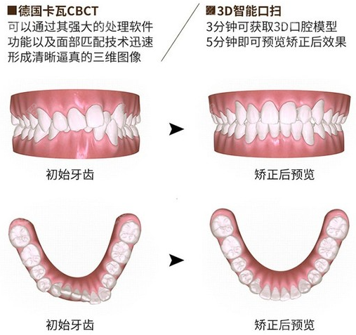 <!--<i data=20240705-sp></i>-->口腔牙齿矫正示意图