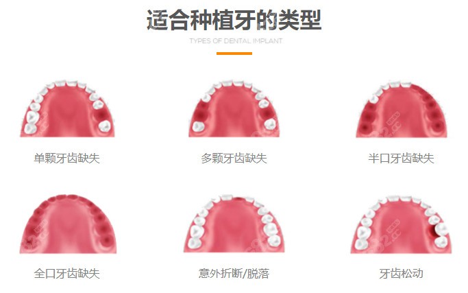 下图是种植牙的适应症