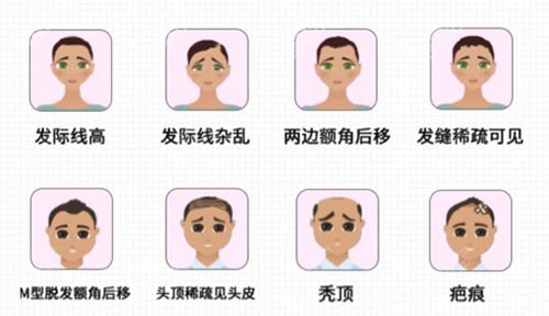 <!--<i data=20240705-sp></i>-->植发治疗脱发问题