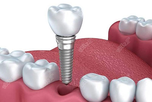 种植牙哪个国材料好性价比高