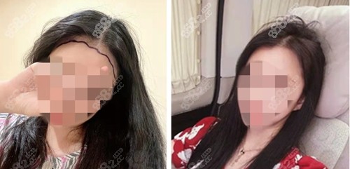 <!--<i data=20240705-sp></i>-->发际线种植前后变化明显