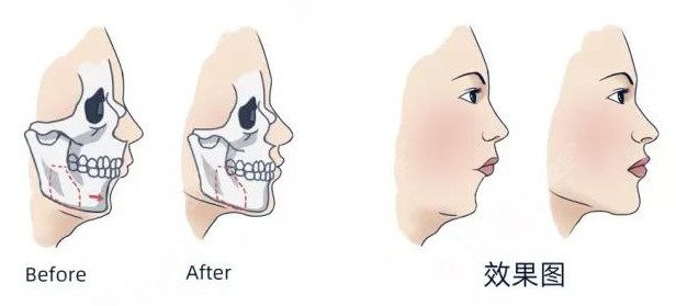 下巴后缩正颌手术前后对比结果图