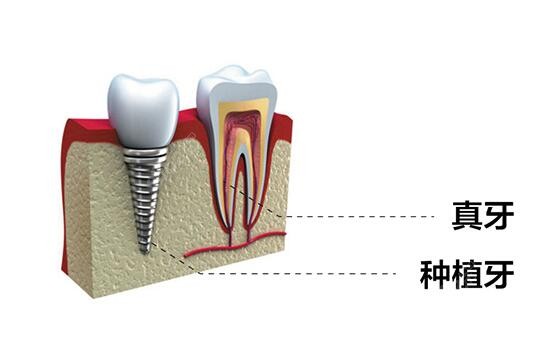 岳阳做单颗、全口种植牙大概多少钱