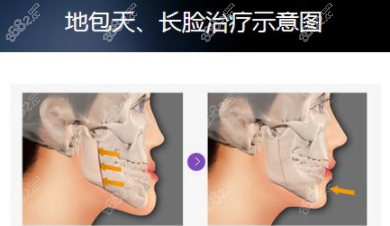 正頜手術(shù)矯正地包天臉型改變圖