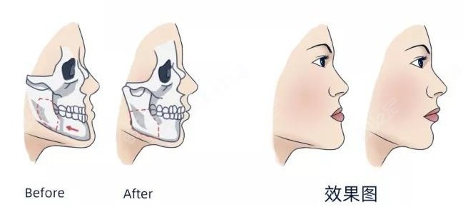 正颌手术前后对比结果图