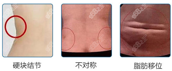 吸脂失败示意图