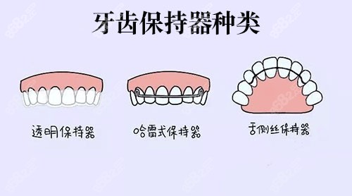 间隙保持器种类图片图片