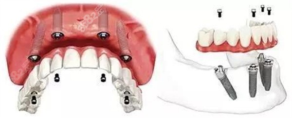 虹桥口腔做全口种植牙的收费